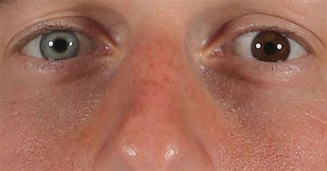 Olhos Com Cores Diferentes Entenda A Heterocromia