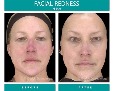 Before And After Gallery Facial Redness Vbeam Derick Dermatology