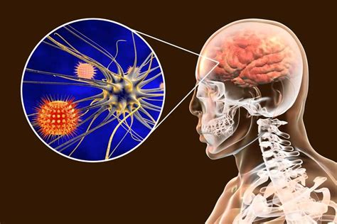 Meningitis Symptoms 11 Most Important Signs Symptoms