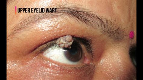 Hpv Warts Vs Pimples How To Remove Papilloma On Eyelids My XXX Hot Girl