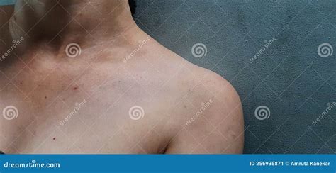 Human Shoulder With Moles Pimples Stretch Marks Pigmentation Stock