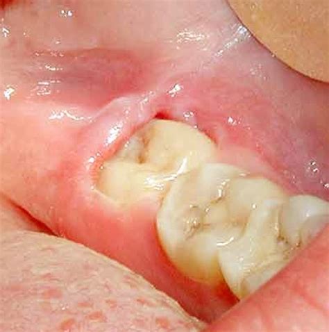 👉 Pericoronitis Pictures Treatment Symptoms Causes February 2022