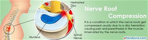 Nerve Root Compression Treatment Causes Symptoms