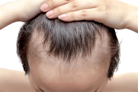 The Best Hair Loss Treatment For Men Prime Hair Clinic