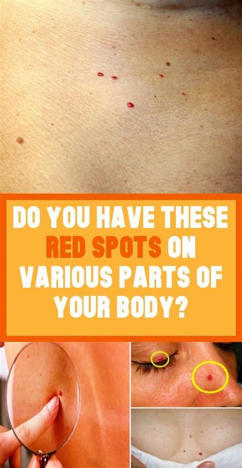 Do You Have These Red Spots On Various Parts Of Your Body Body