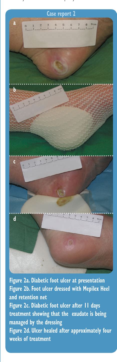 Pdf Management Of Diabetic Foot Ulcers Using Dressings With Safetac