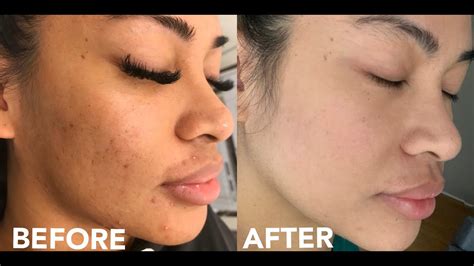HOW I GOT RID OF ACNE SCARS + DARK SPOTS (RF SKIN RESURFACING) 