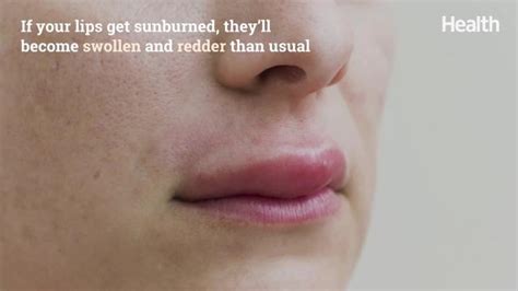 What Helps Swollen Sunburned Lips