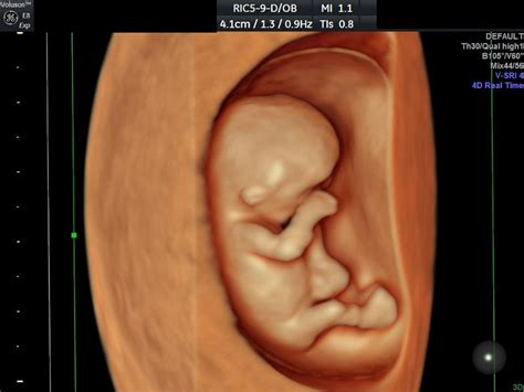Hd Ultrasound My Baby Debut 3d 4d Hd Elective Ultrasound Chicago Il
