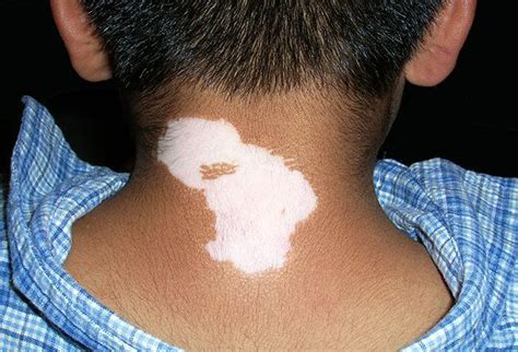 White Patches On Skin How To Cure White Patches On Skin Any Part Of