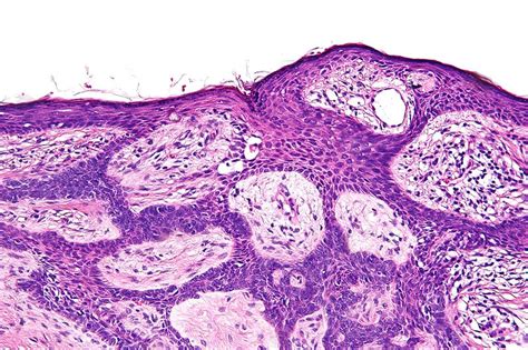 Basal Cell Carinoma Risk Factors Management Teachmesurgery