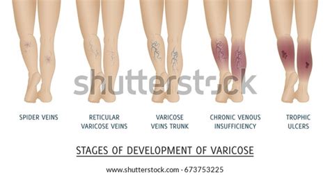 Types Varicose Veins Women Stages Development Stock Vector Royalty