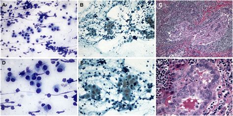 Fine‐needle Aspiration Cytomorphology Of Papillary Thyroid Carcinoma