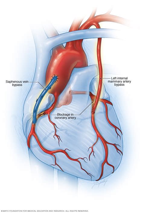 Coronary Bypass Surgery Mayo Clinic