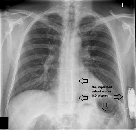 Icd 10 Cm Code For Lump On Chest
