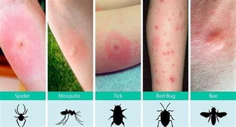 How To Recognize Various Bug Bites Ems