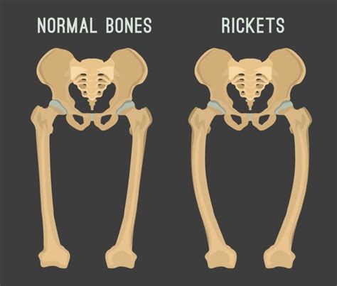 Vitamin D Deficiency Rickets