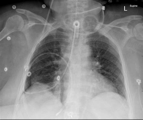 Iatrogenic Bronchopleural Fistula From A Dobhoff Tube Radiology Case