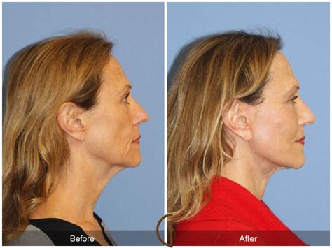 Facelift Fifties Before And After Photos Patient 24 Dr Kevin Sadati
