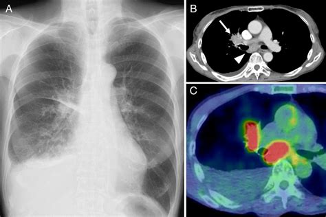Tuberculosis‐associated Chylothorax Revealing An Enlarged Lymphatic