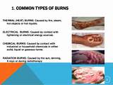 Degrees Of Burns Images