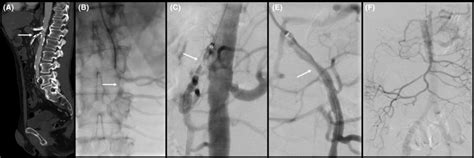 A Chronic Total Occlusion Of The Celiac Axis And Superior Mesenteric