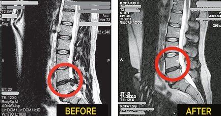 But most herniated discs affect the lower back (lumbar spine). Crews Chiropractic | Spinal Decompression in Shreveport