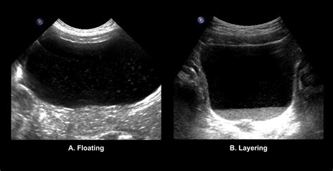 Bladder Debris On Renal And Bladder Ultrasound A Significant Predictor