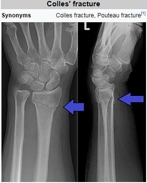 Colles' fracture : 네이버 블로그