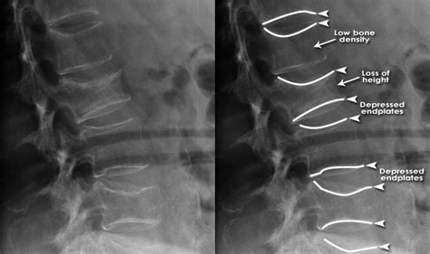 Trauma X Ray Axial Skeleton Gallery 2 Lumbar Spine Fractures