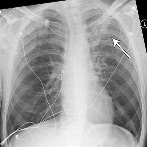Bronchiolitis A Practical Approach For The General Radiologist
