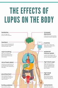 The Effects Of Lupus On The Body Schoen Med In 2021 Lupus Facts