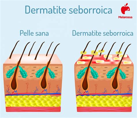 Dermatite Seborroica Cause Sintomi Trattamenti E Rimedi Naturali