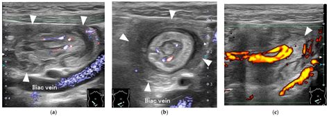 A Pediatric Case Of Inverted Meckels Diverticulum Presenting With