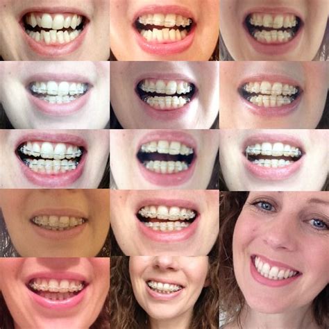 Smile Transformation The Braces Are Off With Images Teeth Braces