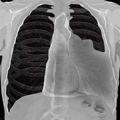 Most common primary neoplasm of pleura. Mesothelioma: How Has Paul Kraus Survived For Over 20 Years?