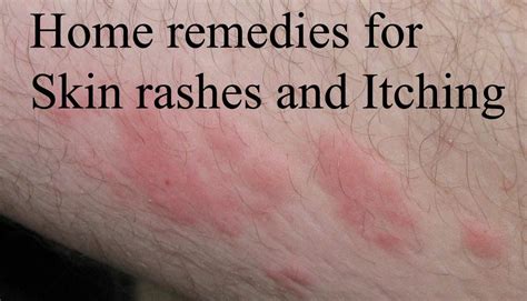 Best Home Remedies For Skin Rashes And Itching Online Bee Home Remedies For Skin Home