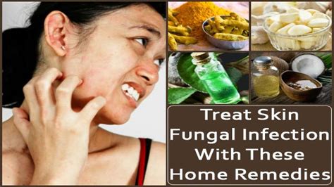 Effective Home Remedies To Treat Skin Fungal Infection
