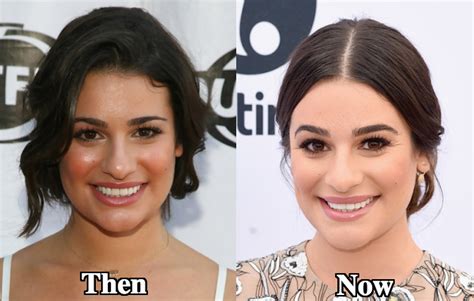 Nose jobs aren't meant to completely change your face and any reputable surgeon will tell you that good plastic surgery should make it impossible to you didn't need a nose job in the first place, is something you'll probably hear on a loop after surgery, but just imagine the weighty insecurity you've. Lea Michele Nose Job Plastic Surgery Before and After ...