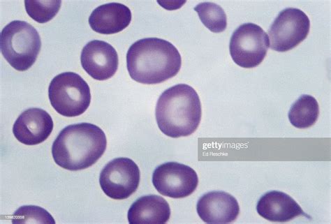 Pernicious Anemia Macrocytic Red Blood Cells 500x At 35mm Many Of The