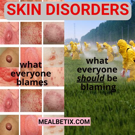 Skin Disorders Autoimmune Finally Know The Cause