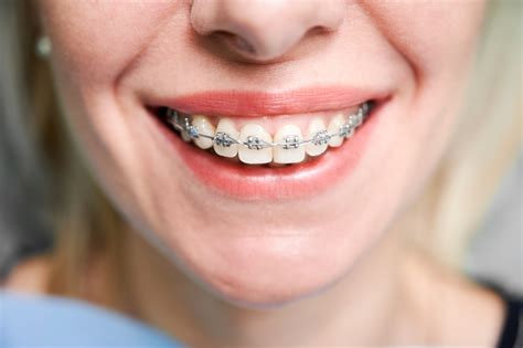 Adult Braces 101 Common Types And Essential Benefits