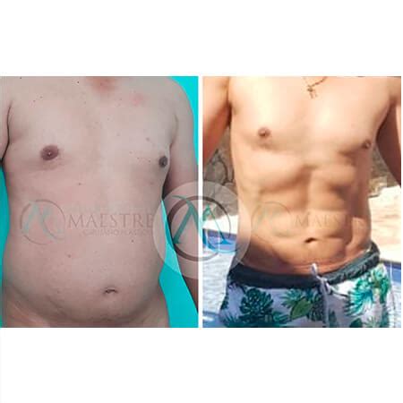 Before And After Liposuction For Men Male Abdominal Etching Melquicedeth Maestre