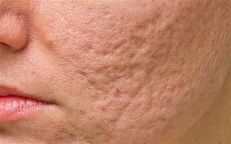 Acne Scar Treatments Recommended By The Dermatologist