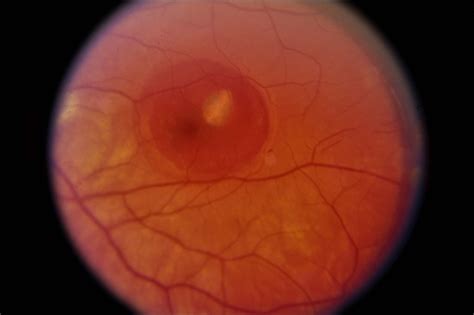 Presumed Ocular Histoplasmosis Syndrome Retina Image Bank