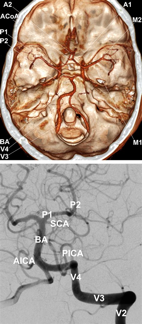 Circle Of Willis Angiogram