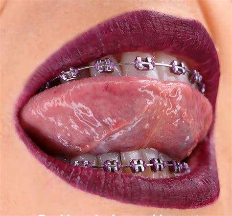 Pin By Dorka🥑 On B R A C E S ️ Teeth Braces Dental Braces Getting Braces