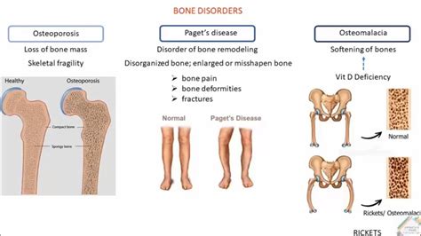 Bone Disorders And Treatment Youtube