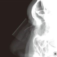 Clavicle (and bones of the upper body): Case of depressed nasal tip fracture (A) X-ray view of ...