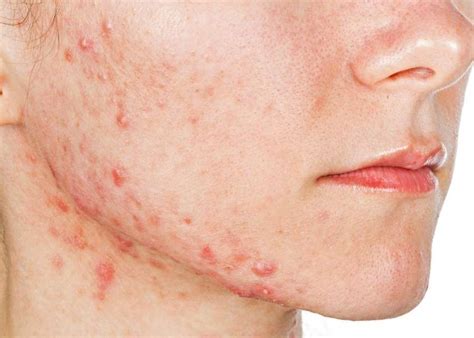 Cystic Acne Causes Treatment Symptoms And Prevention Fabbon